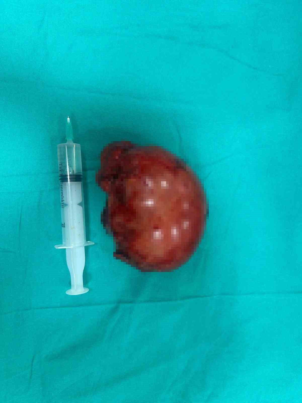 MEAH'da Böbrek Rahatsızlığı Olan Hastaya Başarılı Müdahale